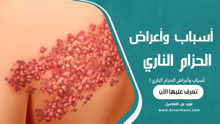 أسباب وأعراض الحزام الناري