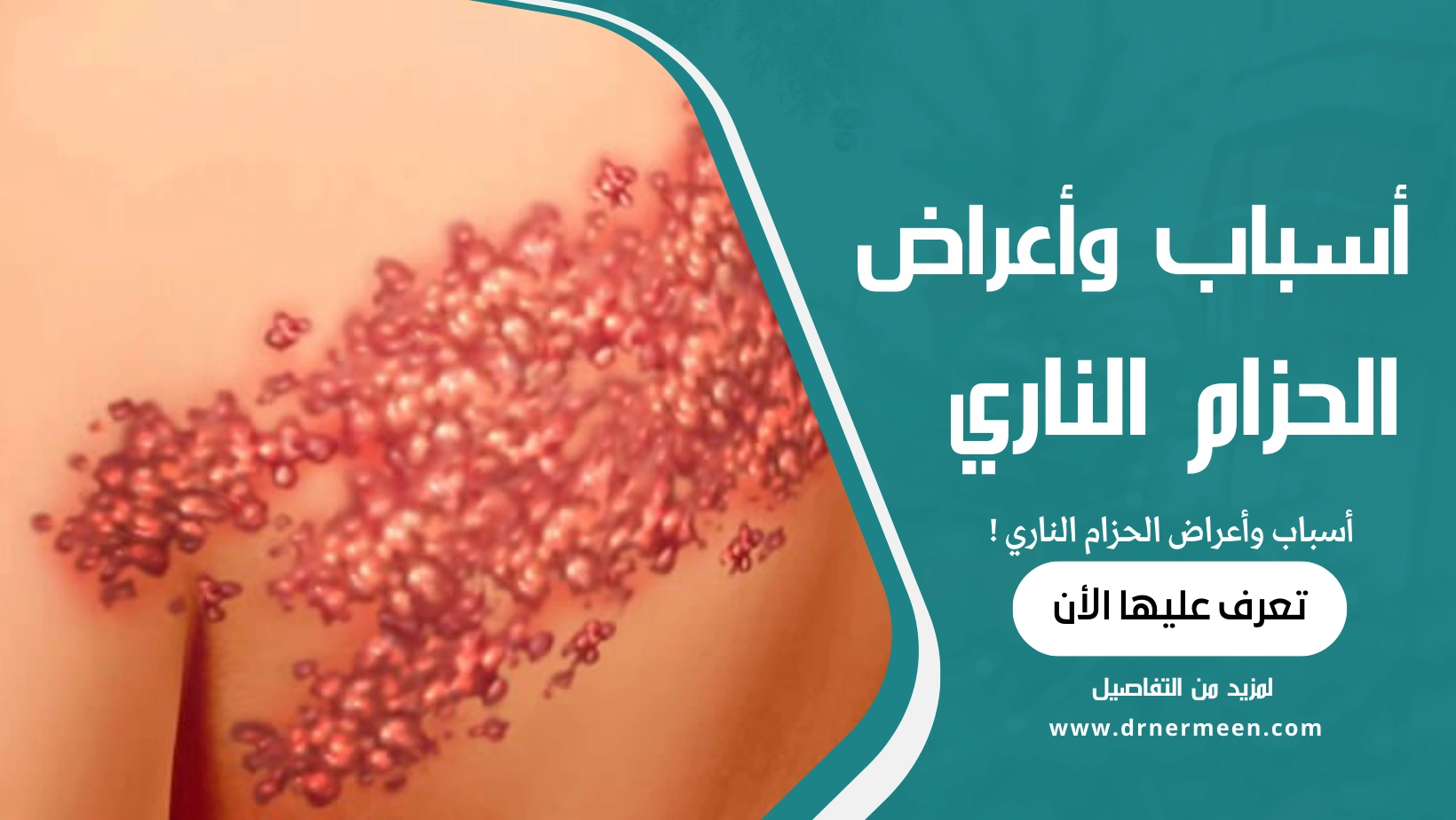 أسباب وأعراض الحزام الناري