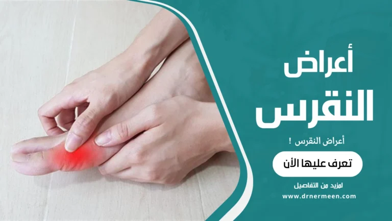 أعراض النقرس الكاملة الأعراض والعلاج