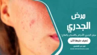 مرض الجدري: الأعراض والاسباب والعلاج