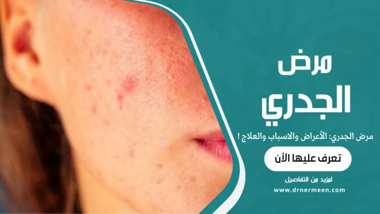 مرض الجدري الأعراض والاسباب والعلاج