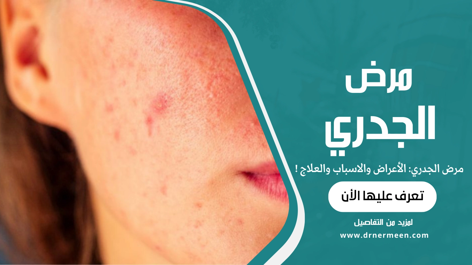 مرض الجدري الأعراض والاسباب والعلاج