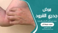 مرض جدري القرود الاعراض والاسباب
