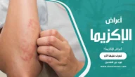 أعراض الإكزيما