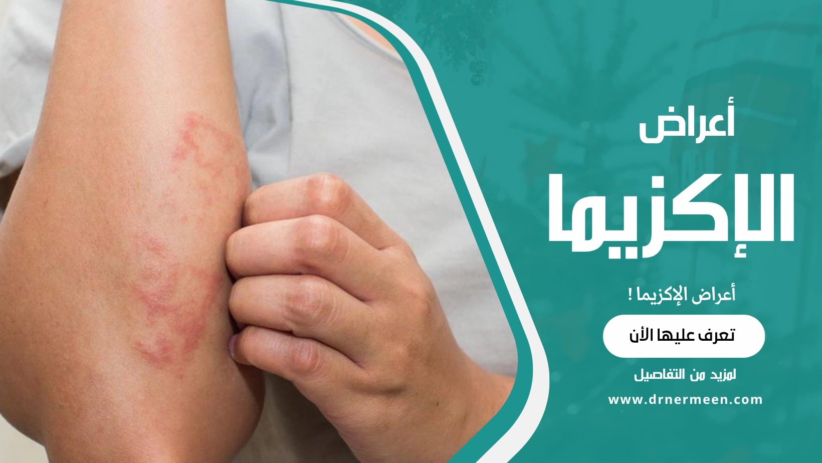 أعراض الإكزيما