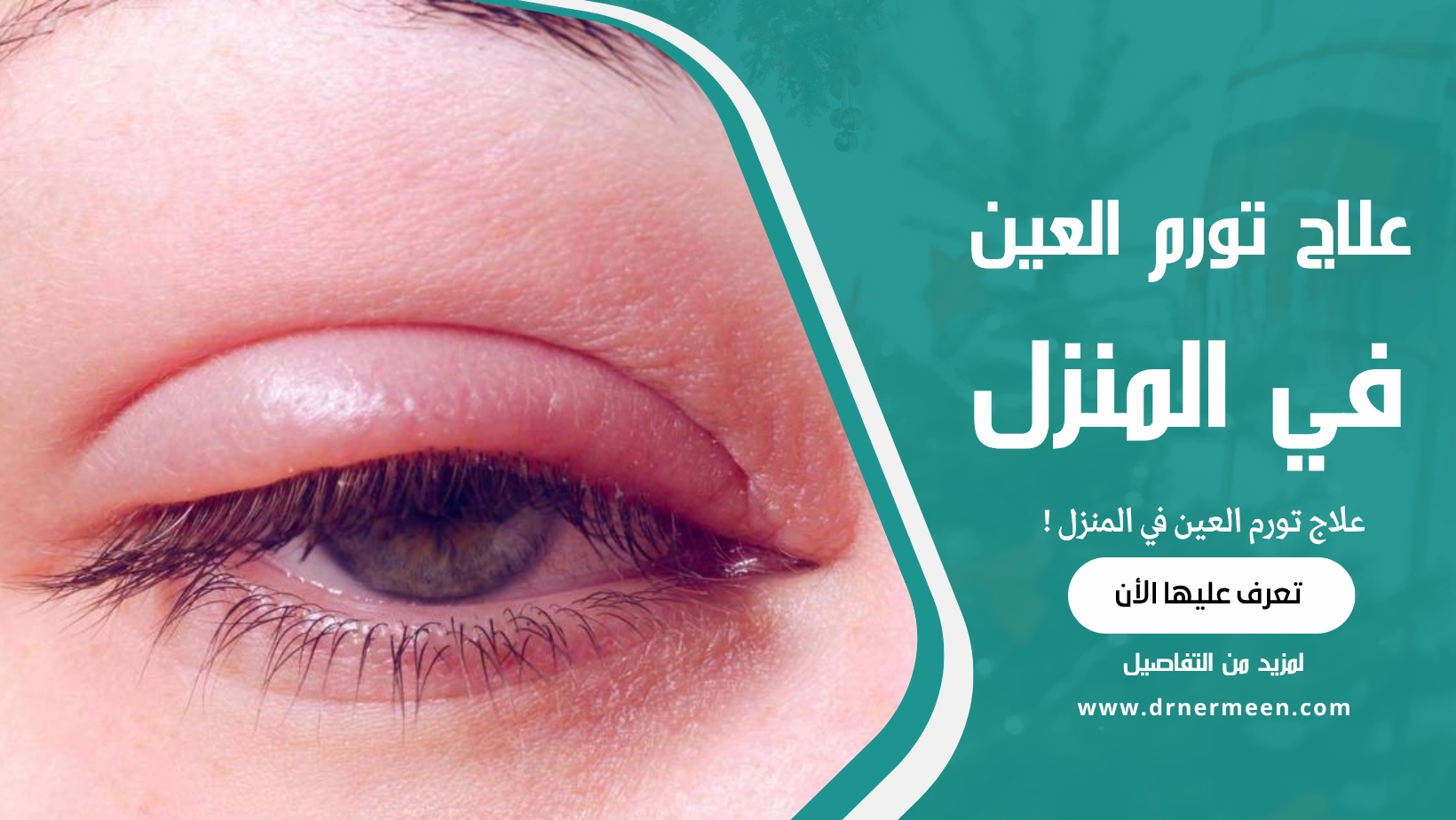 علاج تورم العين في المنزل