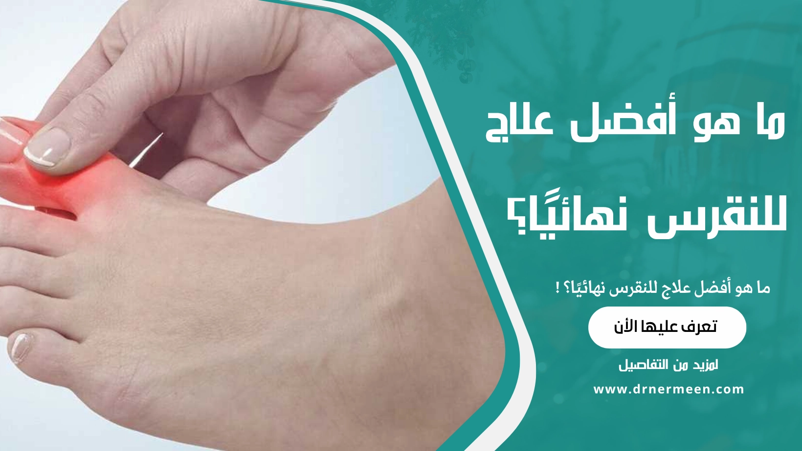 ما هو أفضل علاج للنقرس نهائيًا؟