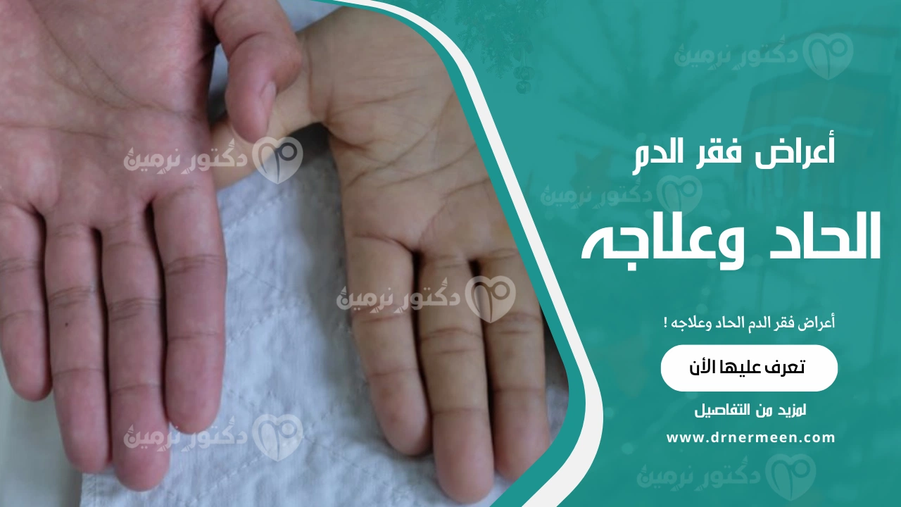 أعراض فقر الدم الحاد وعلاجه