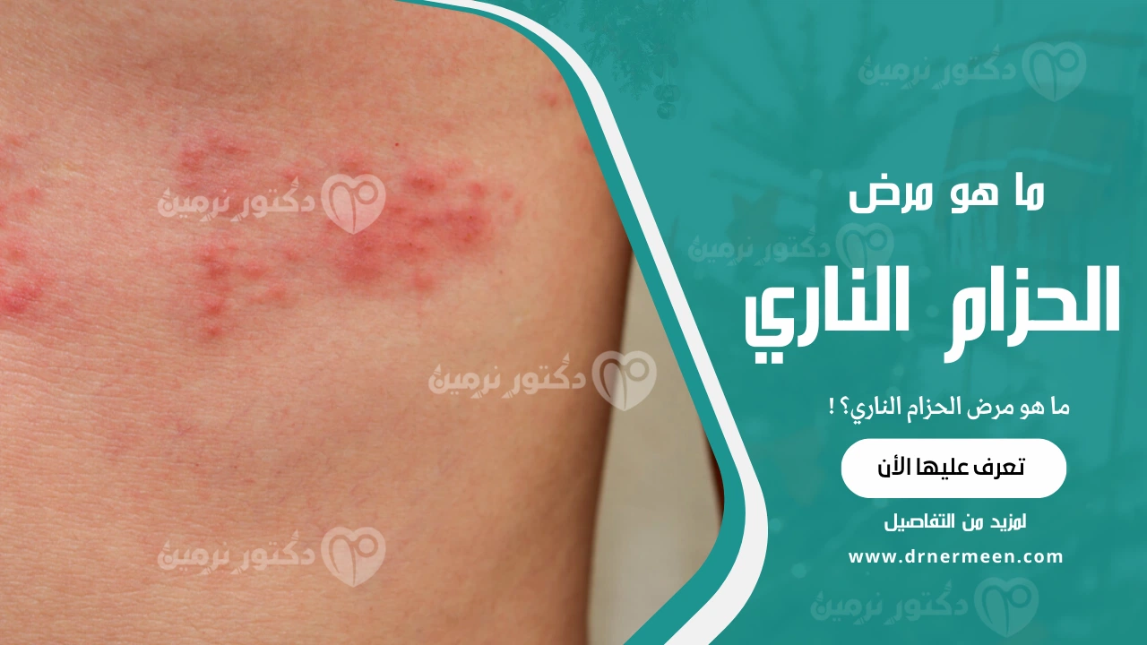 ما هو مرض الحزام الناري؟