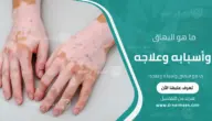 ما هو البهاق وأسبابه وعلاجه