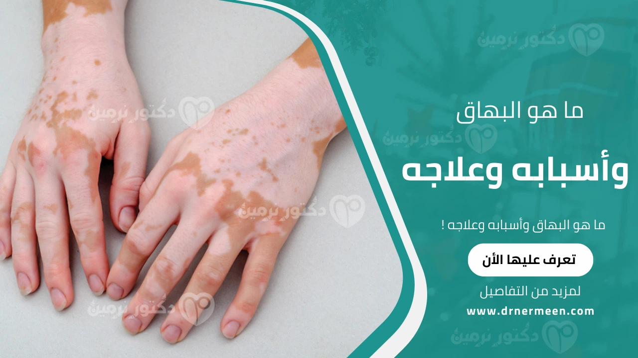 ما هو البهاق وأسبابه وعلاجه