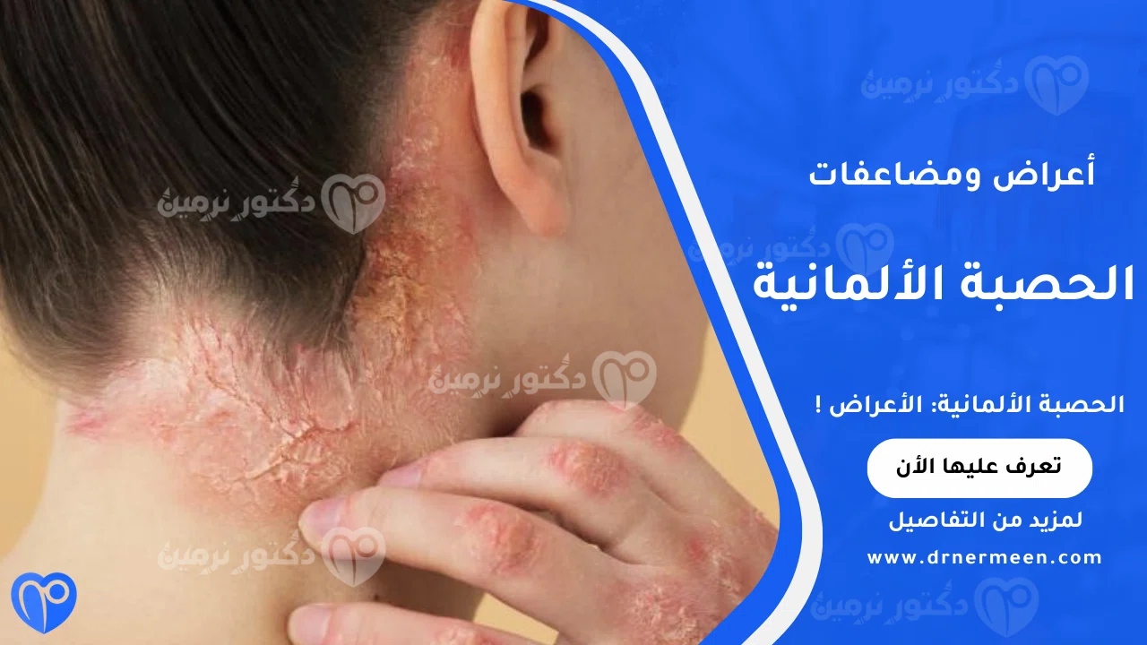 الحصبة الألمانية وأعراضها وطرق انتقال العدوى والوقاية منها