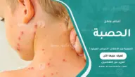 الحصبة عند الأطفال: الأعراض المبكرة وطرق العلاج والوقاية