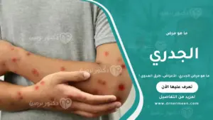 ما هو مرض الجدري وأعراضه وطرق العدوى وكيفية الوقاية منه