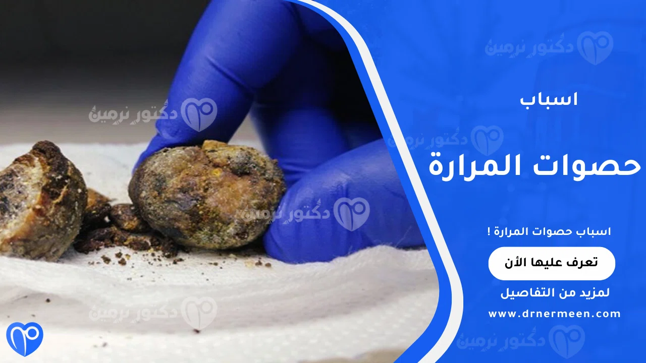 اسباب حصوات المرارة الشائعة وتأثيرها على صحة المرارة