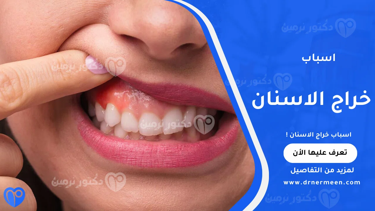 اسباب خراج الاسنان الشائعة وتأثيرها على صحة الفم