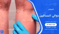 اسباب دوالي الساقين: العوامل وطرق الوقاية