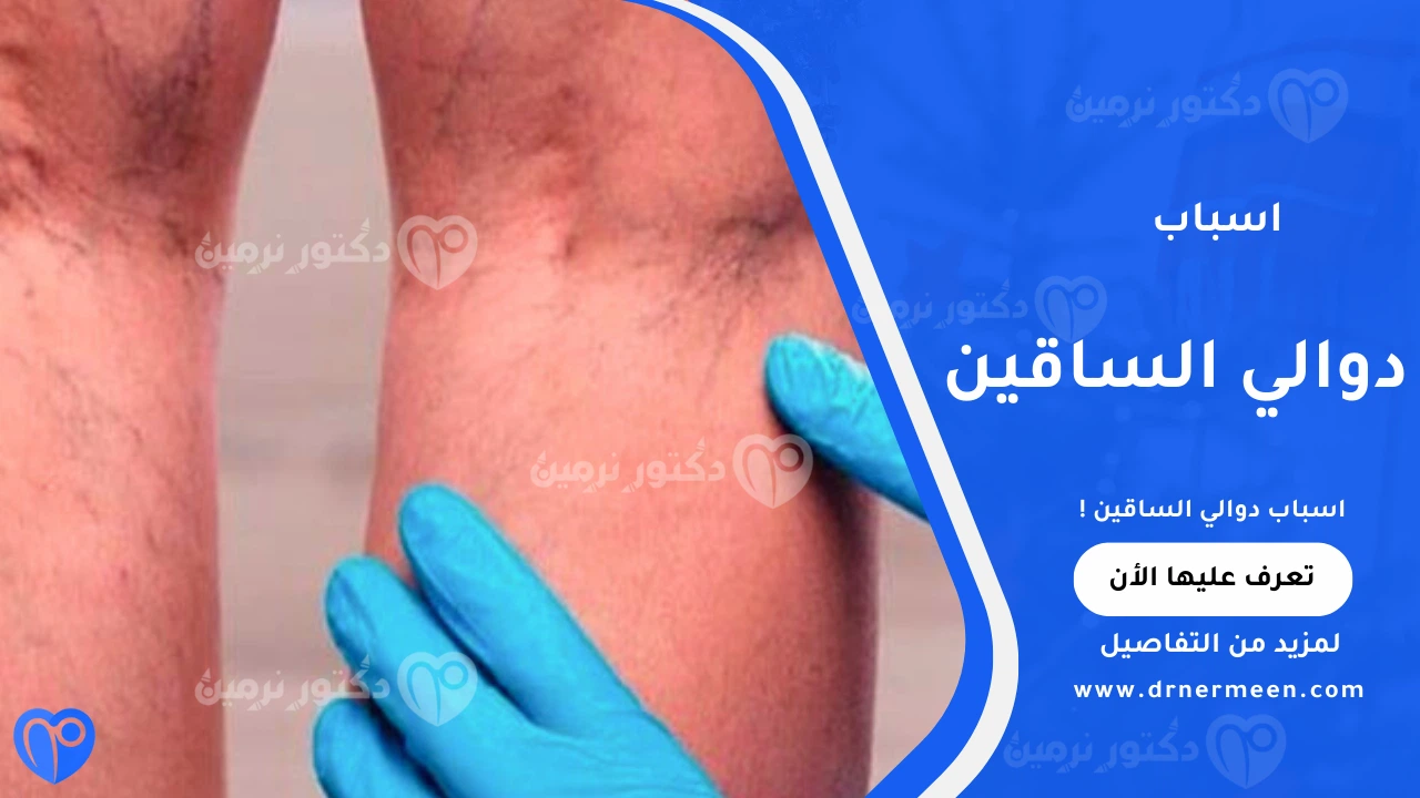 اسباب دوالي الساقين: العوامل وطرق الوقاية