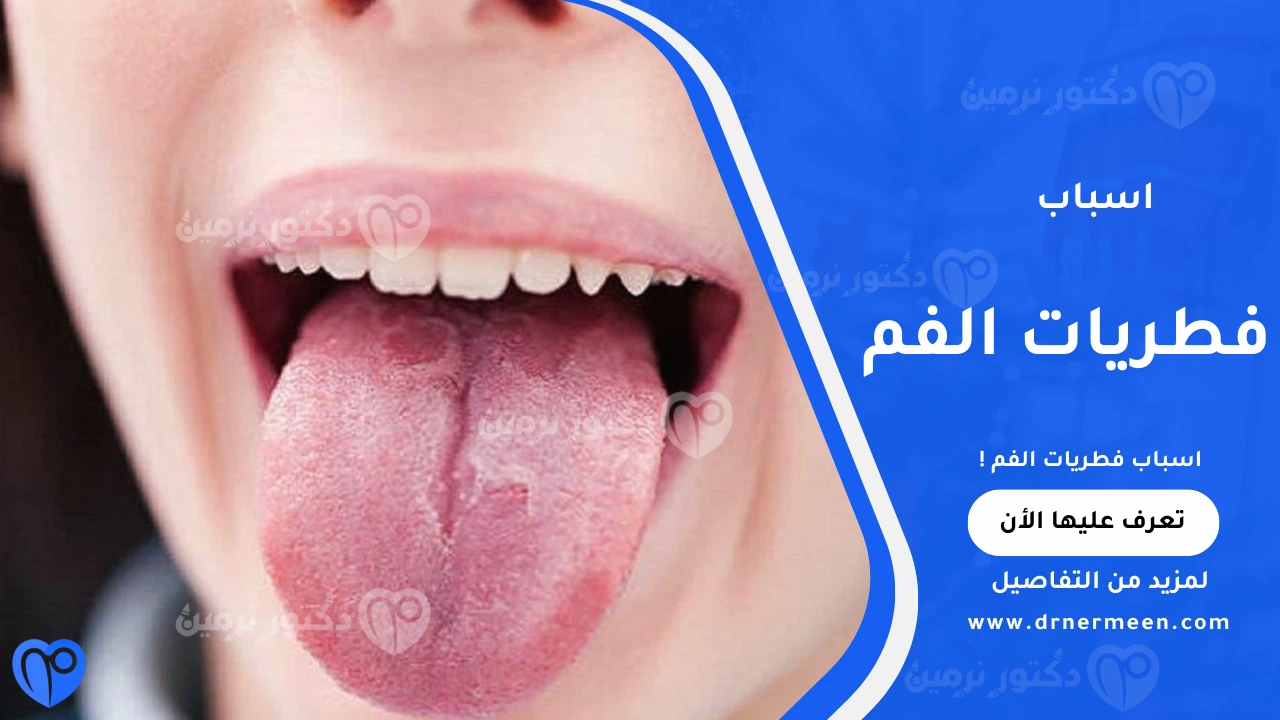اسباب فطريات الفم الشائعة وتأثيرها على صحة الفم واللسان