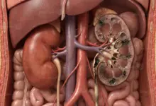 أضرار التدخين على الكلى وتأثيره السلبي على وظائف الكلى