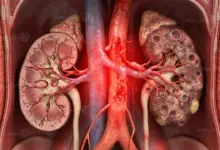 العلاقة بين ارتفاع ضغط الدم وصحة الكلى وتأثير الضغط على وظائف الكلى