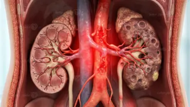 العلاقة بين ارتفاع ضغط الدم وصحة الكلى وتأثير الضغط على وظائف الكلى