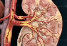 تأثير ارتفاع الكوليسترول على الكلى وأهم الأضرار الناتجة عن ارتفاع الدهون في الدم
