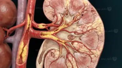 تأثير ارتفاع الكوليسترول على الكلى وأهم الأضرار الناتجة عن ارتفاع الدهون في الدم